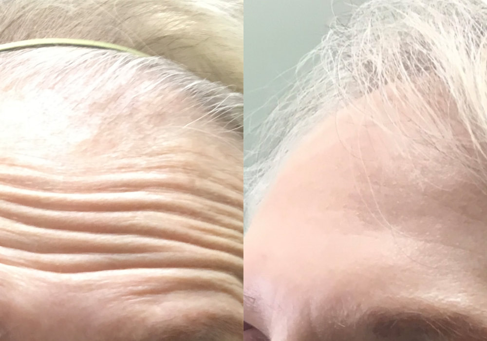 Botox before and after of 82 year old female by CollaJenn Aesthetics Botox injector