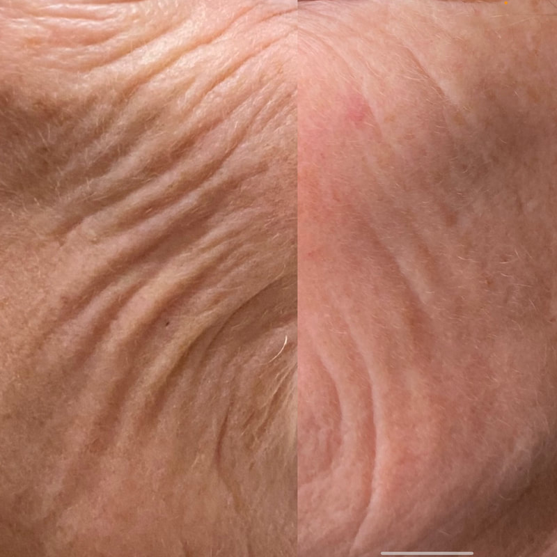 Plump aging skin, improve texture, and tone with Collagen Induction PRP from CollaJenn Aesthetics