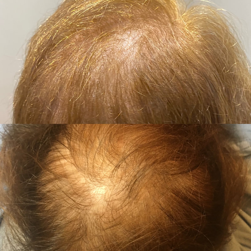 Hair restoration with PRP after 3 treatments from CollaJenn Aesthetics