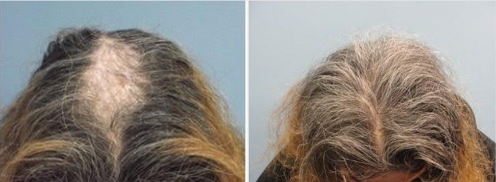 Hair restoration with PRP from CollaJenn Aesthetics