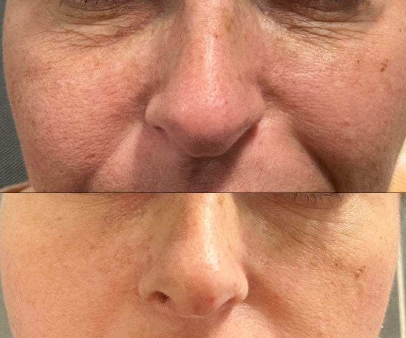 Under-eye treatment with to improve skin texture using PRP and VI Peel  by CollaJenn Aesthetics