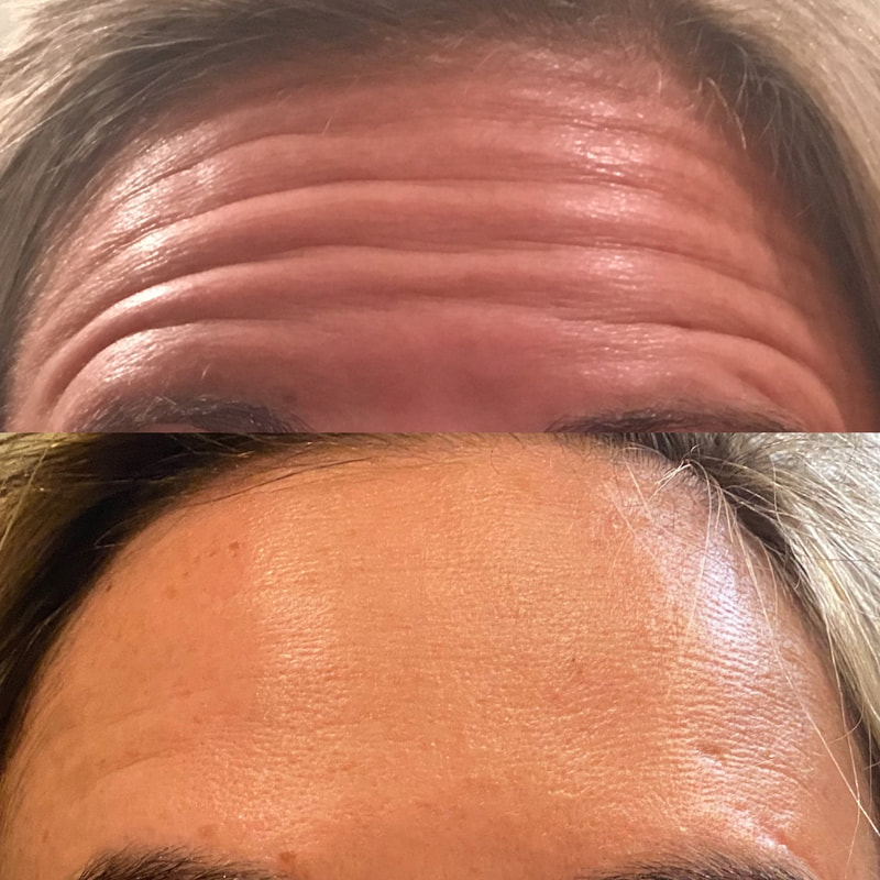 Botox for forehead wrinkles before and after