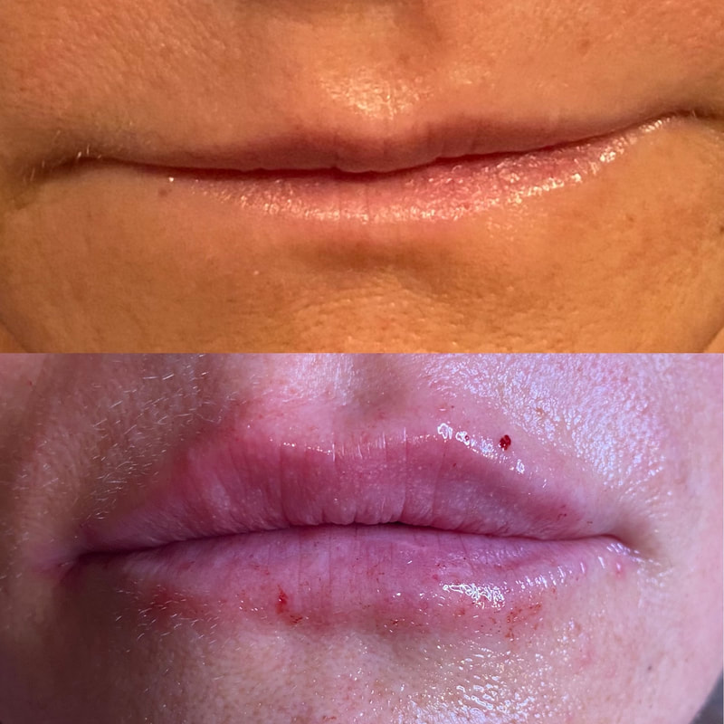 CollaJenn Aesthetics lip filler for natural-looking enhanced lips