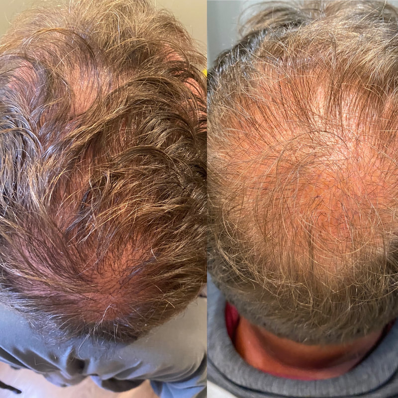 CollaJenn Aesthetics Before and after PRP treatments for hair restoration