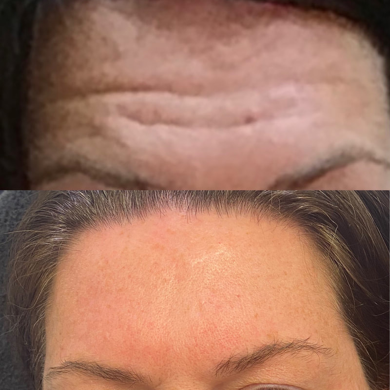 Botox for forehead wrinkles after 5 years of consistent Botox treatments