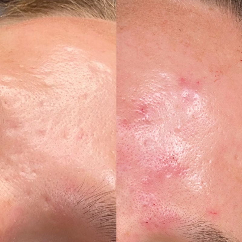 Collagen Induction with PRP and Vampire Facial from CollaJenn Aesthetics to plump scars and improve skin imperfections