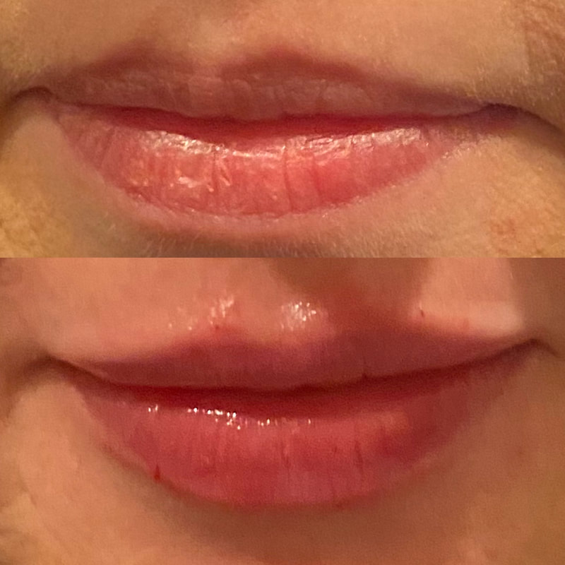 CollaJenn Aesthetics lip filler for natural-looking enhanced lips