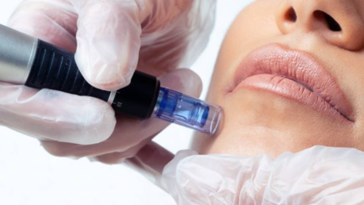 CollaJenn Aesthetics PRP micro needling, also known as a Vampire Facial, to restorer collagen and volume, and treat wrinkles on the face and neck.