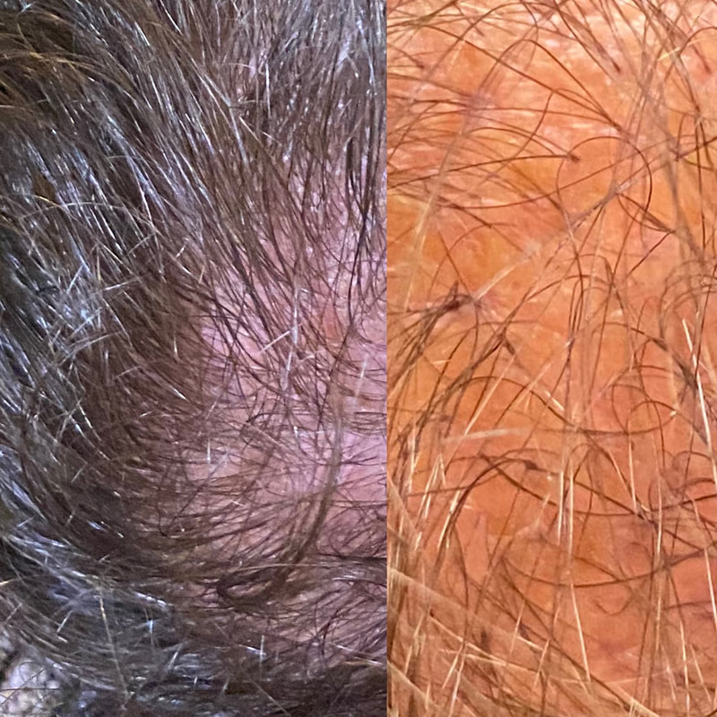 CollaJenn Aesthetics hair restoration and rejuvenation using PRP