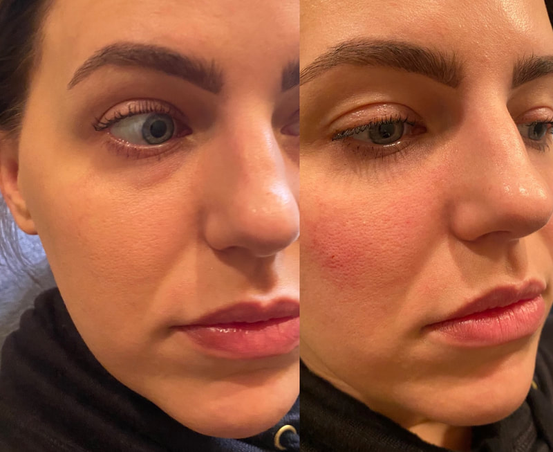 Malar cheek injection with Restylane injected with cannula to treat tired eyes by CollaJenn Aesthetics