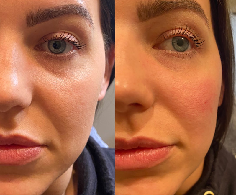 Malar cheek injection with Restylane to treat tired eyes by CollaJenn Aesthetics