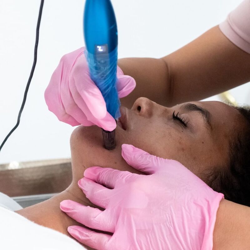 CollaJenn Aesthetics PRP micro needling, also known as a Vampire Facial, to restorer collagen and volume, and treat wrinkles on the face and neck.