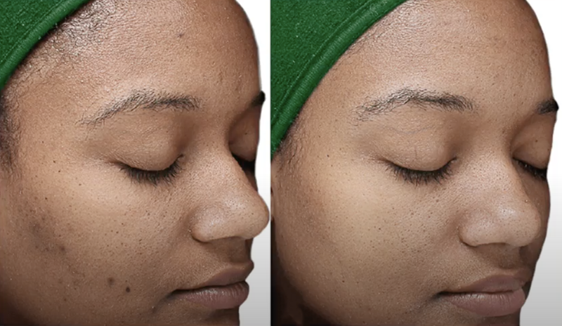 VI Peel from CollaJenn Aesthetics - Chemical peel to improve skin tone and texture