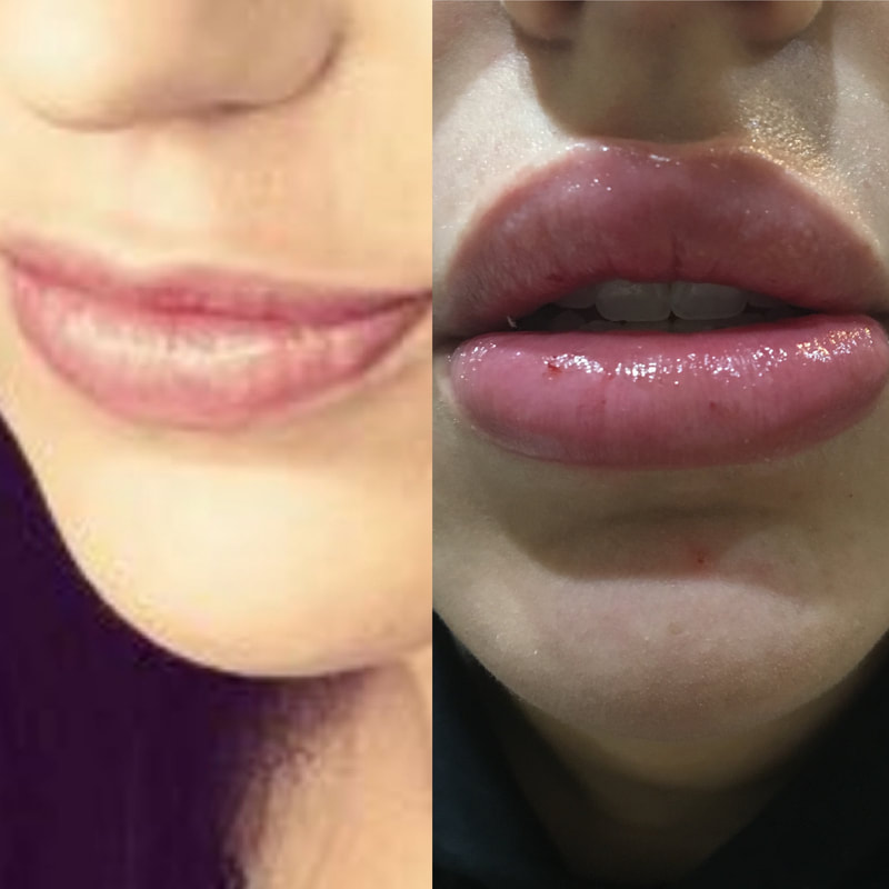 Juvederm Ultra Plus for voluminous lips - lip filler by CollaJenn Aesthetics
